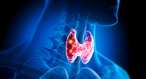 L'Impatto Silenzioso dell'Ipertiroidismo: Come la Malattia di Graves Cambia la Composizione Corporea e le Abitudini Alimentari